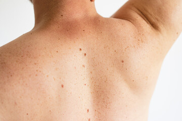 Wall Mural - Pigmentation. Close up detail of the bare skin on a man back with scattered moles and freckles. Checking benign moles. Birthmarks on skin