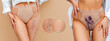 © _KUBE_ - Banner. Slim woman in lingerie and a white shirt poses on a beige background, showing a vascular mesh on her thigh and results after medical procedure. The concept of varicose veins