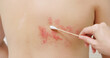 © ryanking999 - man with shingles disease