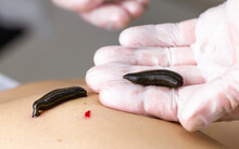 A Medical Leech Full Of Blood Lies On The Palm Of Hand, Wearing A Glove