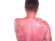 A man with a painfully tanned back and sunscreen on a white background, sunburned red