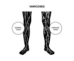 Poster - Varicose veins treatment