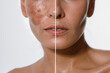 Hyperpigmentation of female skin, close-up of a part of the face on a white background, before and after acid peeling and cosmetic therapy, dermatology, skin care