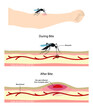 illustration of biology and animals, mosquito sucking blood on human body, Mosquito cartoon sucking blood from human skin, mosquito transmits dengue viruses to humans through bites