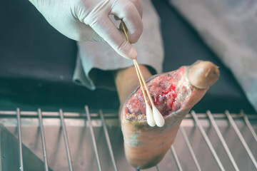 infected wound of diabetic foot. The largest infected wound. Treated by a specialist doctor.