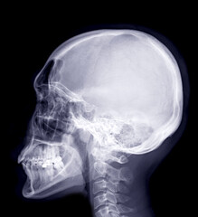 Poster -  Skull x-ray image of Human lateral view.