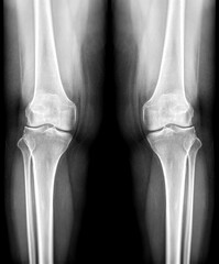Poster - film x-ray both knee joint ap view