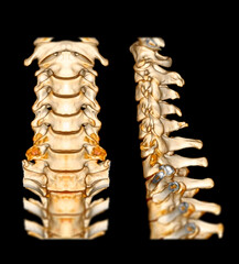 Poster - CT SCAN of Cervical Spine ( C-spine ) patient trauma case 3D rendering image . Medical technology concept.