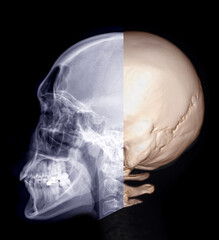 Poster -  Skull x-ray image of Human lateral view and 3D rendering  image  isolated on Black Background.