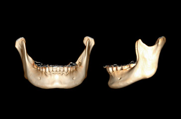 Poster - CT SCAN of Mandible bone 3D rendering image .