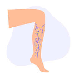 Poster - Varicose veins treatment