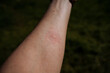 A blister mark from a midge bite on the human body, a red spot from a mosquito bite, reddening of the skin, itching on the body.