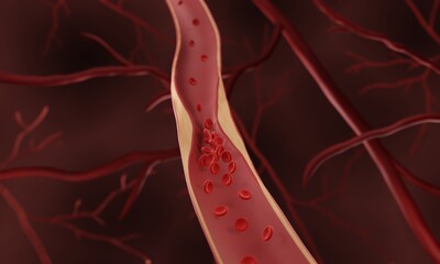 Atherosclerosis, Cholesterol and fat accumulating in arteries (plaque) leading to occlusion (blockage of blood vessel)