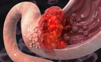 Stomach cancer. Cancer attacking cell. Stomach disease concept. 3d illustration