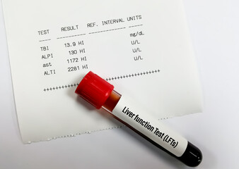 Poster - Blood sample isolated for Liver function test (LFTs) including ALT, AST, ALP and Total bilirubin with abnormal patient report.