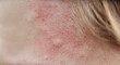© Евгений Вершинин - Bite mark, sting or sore on human skin. Close up of symptoms. Healthcare theme.