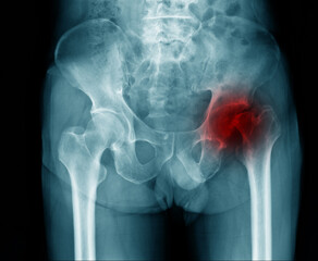 Poster - hip fracture at intertrochanteric