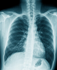 Canvas Print - chest x-ray image in blue tone