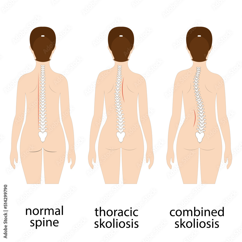 Spine deformation types and healthy spine comparison diagram poster
