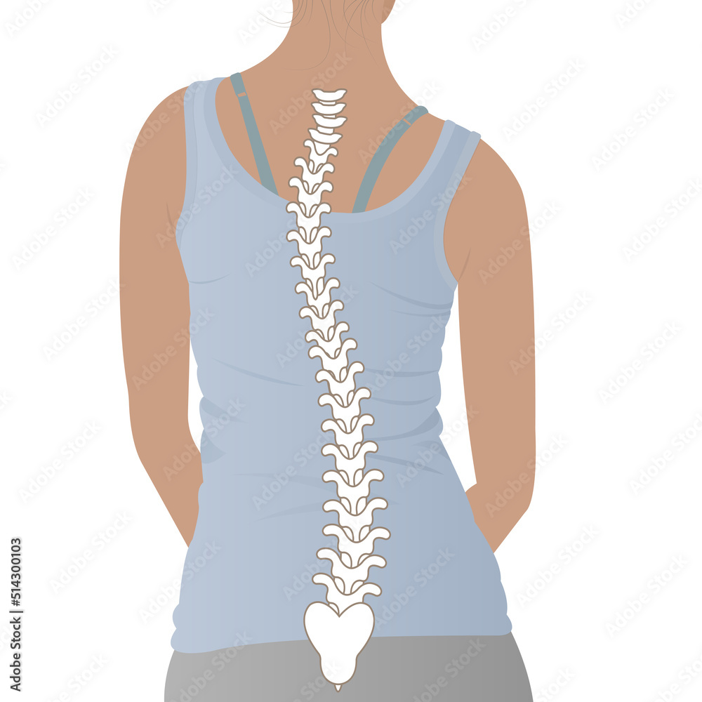 Spine deformation types and healthy spine comparison diagram poster ...