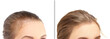 Thinning hair and hair loss,female pattern baldness,Hair transplant