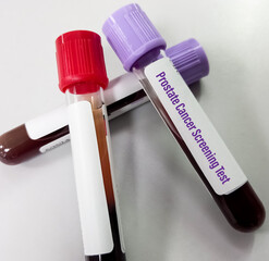 Poster - Blood sample for Prostate cancer screening test. Prostate specific antigen(PSA) test to diagnosis of prostate cancer.