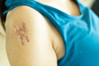 Woman having large hypertrophic scar on her right upper arm due to injury or vaccination adverse side effect
