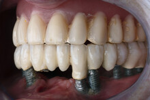Unsuccessful Dental Implantation Where All Implants Are Bare And Not Bones With A Prosthesis, Side View