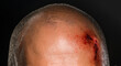 abrasion on the head close-up isolated