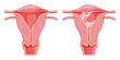 Set of Asherman syndrome Female reproductive system scar tissue adhesions in uterus. Front view in a cut. Sick and normal Human anatomy internal organs location scheme fallopian tube flat style icon