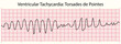 ECG: Ventricular Tachycardia Torsades de Pointes