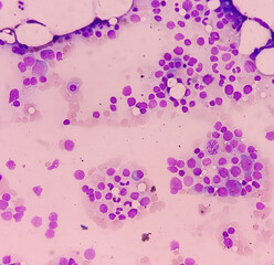 Poster - Microscopic view of bone marrow slide, acute myeloid leukemia(AML), type of blood cancer,abnormal myeloblasts.