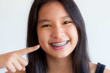 portrait of asian woman face with colorful braces and smile happily