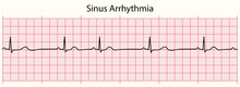 ECG Line: Sinus Arrhythmia In 6 Second ECG Paper Line