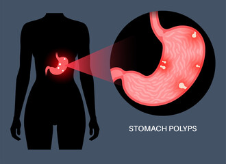 Canvas Print - Stomach polyp disease