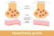 Myasthenia gravis. An autoimmune disease of the neuromuscular junction when antibodies block or destroy nicotinic acetylcholine receptors (AChR) at the junction between the nerve and muscle.