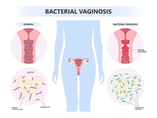 Types of herpes simplex virus Vagina bacterial sex odor fishy Foul smelling good Preterm birth of HIV AIDS and Pelvic trich cervix yeast pap smear cancer pain rash lactic acid tract syndrome atrophy