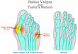 © LuckySoul - Tailor 's Bunion, hallux valgus anatomy. Foot bones, joint deformity feet. Top foot x ray, angle of  little pinky, big toe symptom structure. Orthopedic patients surgery. Illustration medical vector
