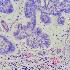 Poster - Camera photo of basal cell carcinoma of the skin tissue, showing tumor sheet with cleft artifact, magnification 400x, photograph through a microscope