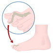 Hammer toe deformity. Medical poster. Vector illustration