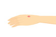 Hand with Red bumps is caused by skin disease, Basal cell carcinoma, or skin cancer. Illustration about medical and health checks.
