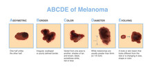 Different Characteristics Of Skin Damage. ABCDE Stands For Asymmetry, Border, Color, Diameter, And Evolving. Medical Diagram For Diagnosing And Classifying Melanomas And Treatment.