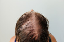 Hair Loss In The Form Of Alopecia Areata. Bald Head Of A Woman. Hair Thinning After Covid. Bald Patches Of Total Alopecia
