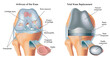 Medical illustration shows an arthrosis of the knee and total knee replacement, with annotations.