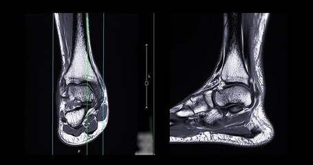 Poster - mri ankle joint coronal and sagittal t2 for diagnosis tendon of ankle joint injury.