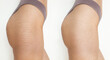 stretch marks before and after
Hips after stretch mark removal treatment