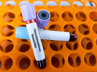 Canvas Print - Blood sample for Primary Immunodeficiency Diseases(PIDDs) test.