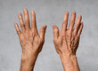 © ZAY WIN HTAI - Age spots on hands of Asian man. They are brown, gray, or black spots and also called liver spots, senile lentigo, solar lentigines, or sun spots.
