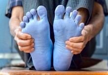 Light Blue Colored Feet Of Asian Man. Concept Of Cold And Clumsy Foot.