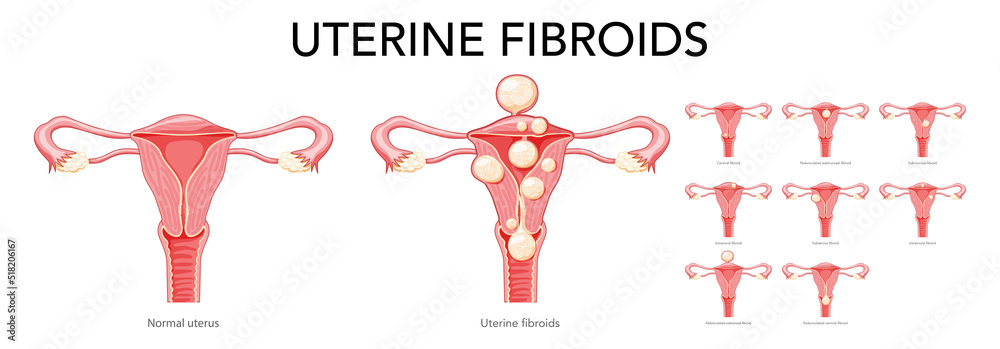 Set of Uterine fibroids Female leiomyomas reproductive system uterus ...